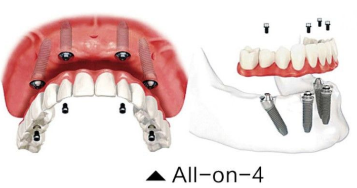 Fixed Prosthodontic Restorations: Common Clinical & Laboratory Problems and Practical Solutions